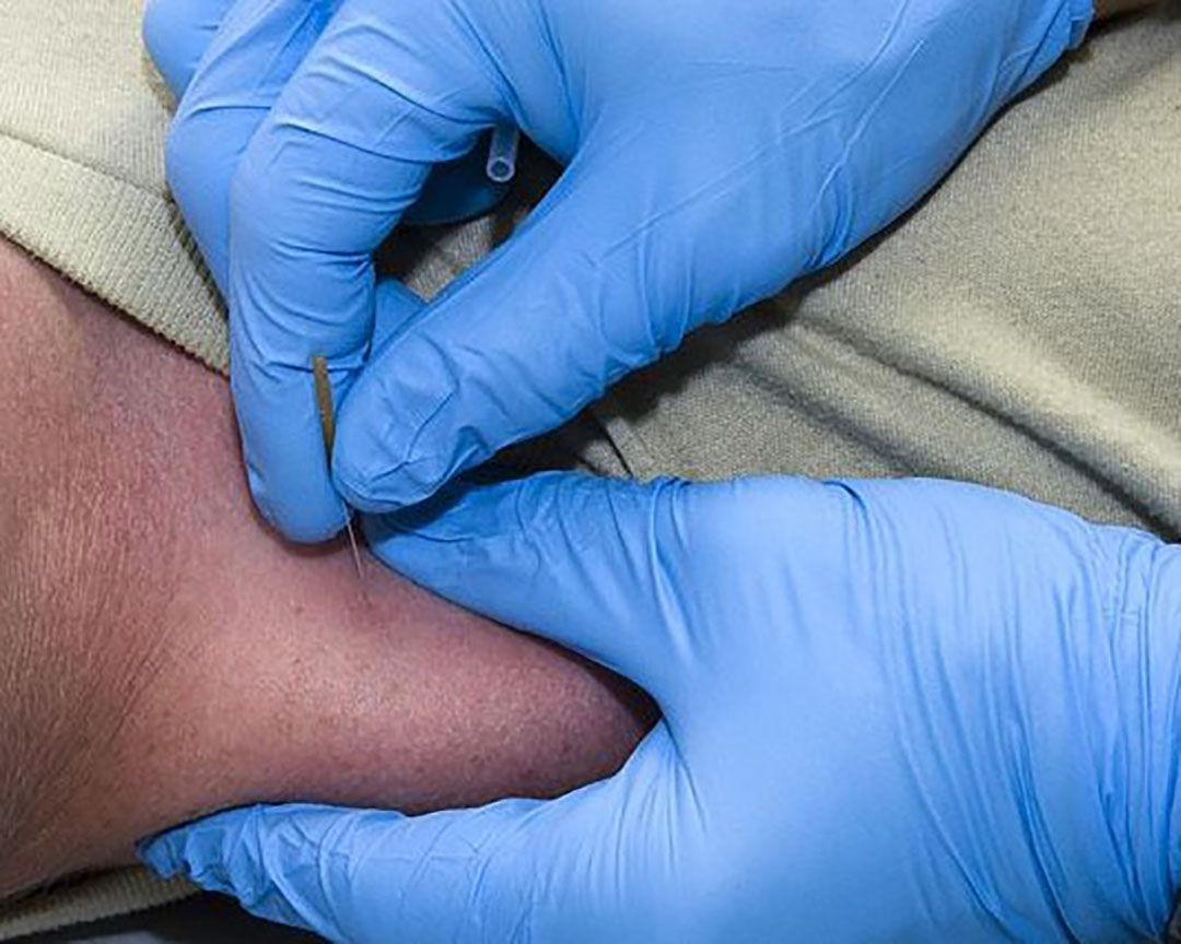 Dry Needling